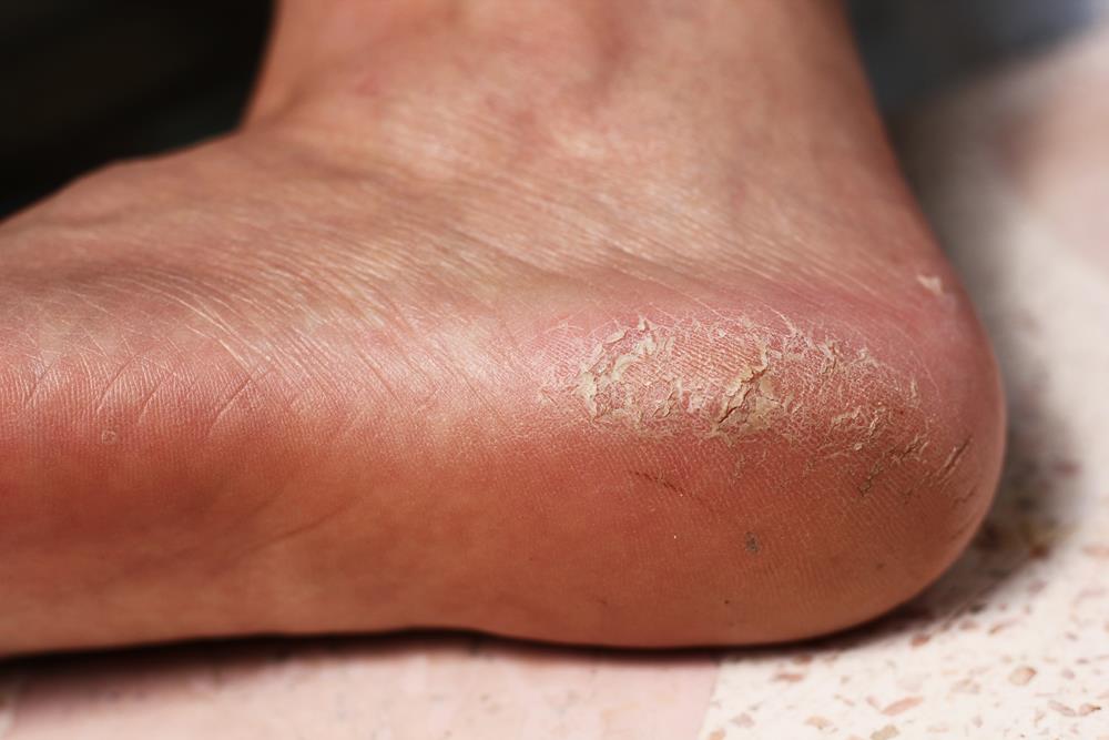 Calluses Tucson, AZ