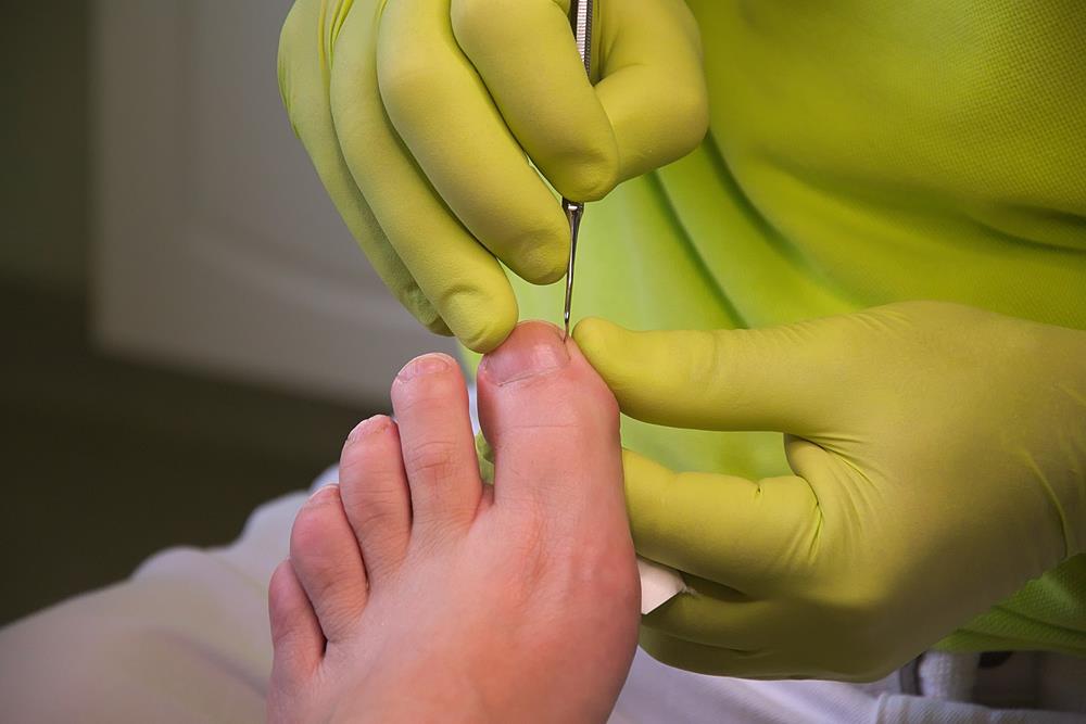 Ingrown Toenails Tucson, AZ